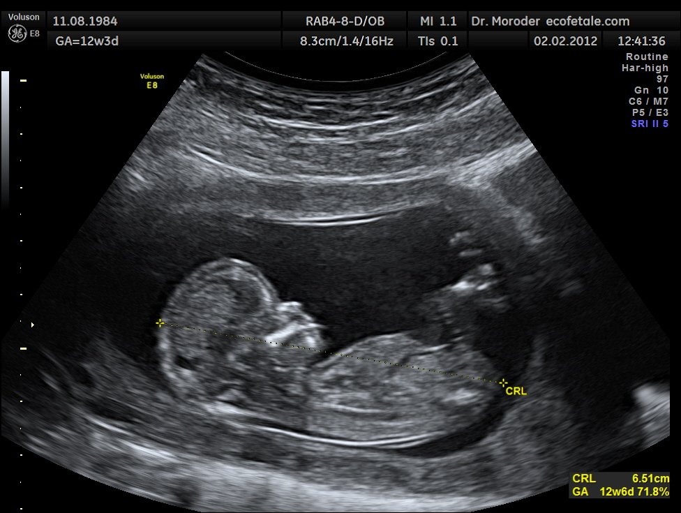 Imagen de referencia de ecografía fetal en modo B