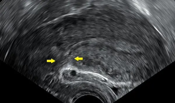 Imagen de referencia de ecografía transvaginal del útero en modo B